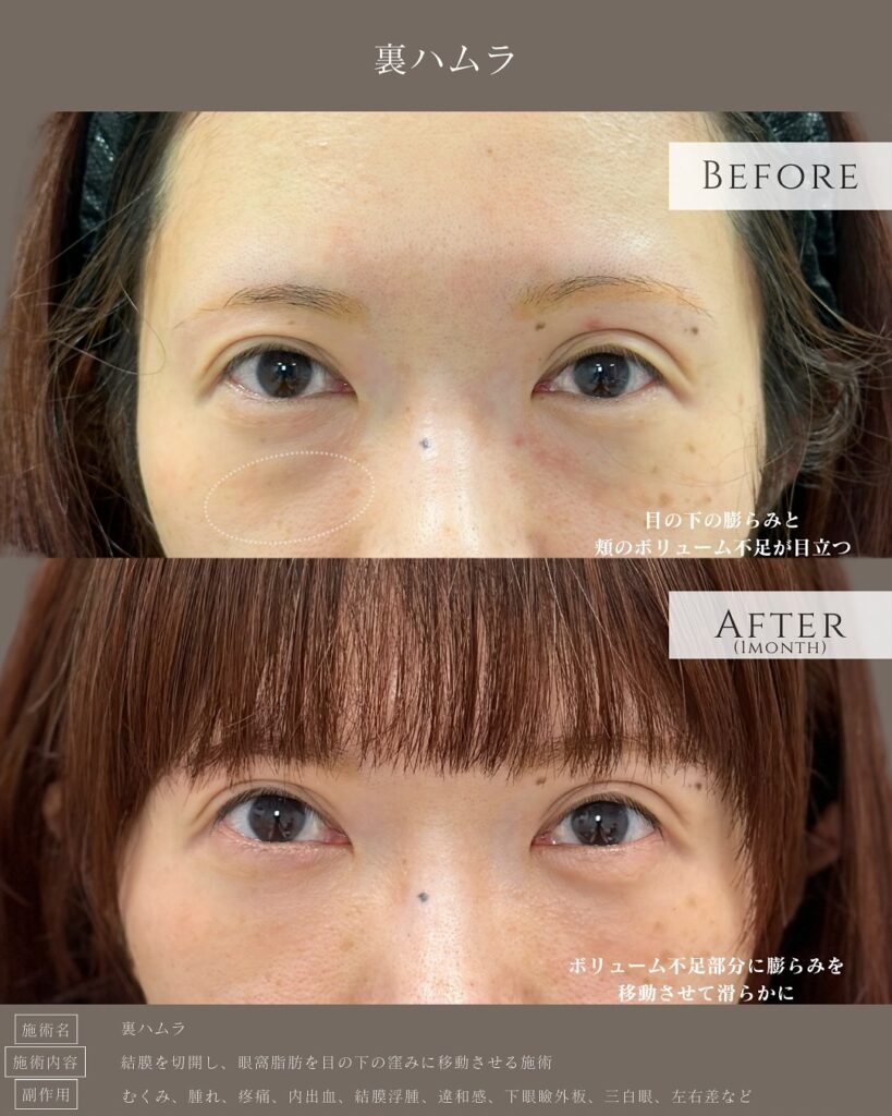 裏ハムラ法の症例写真 (46)