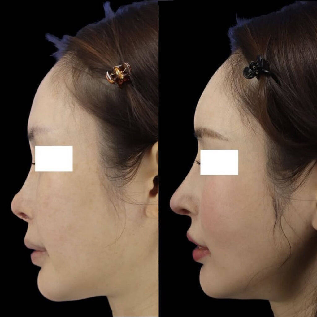 鼻感染後修正と額のエランセ注入とシーカール形成と裏人中の症例写真