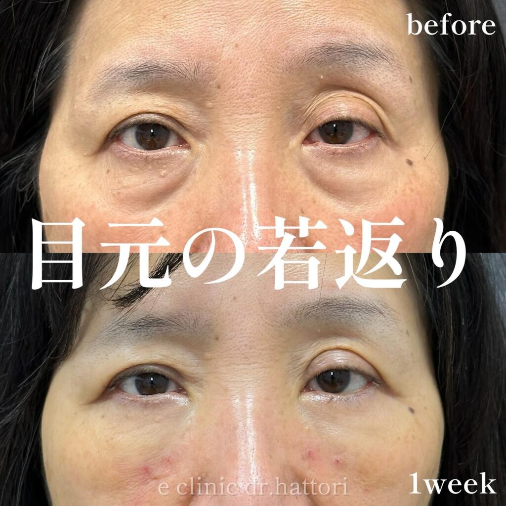 裏ハムラ法の症例写真 (79)