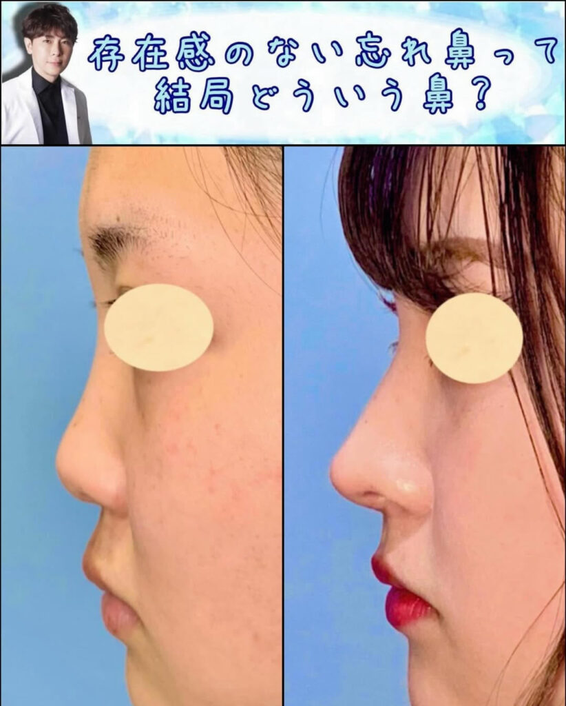 鼻中隔延長と鼻尖形成と軟骨移植と小顔脂肪吸引の症例写真 ｄ