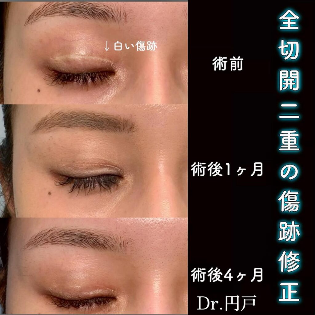 全切開+眼瞼下垂の他院修正の症例写真