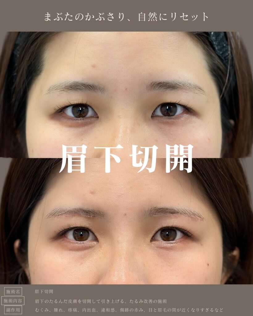眉下切開の症例写真 (5)