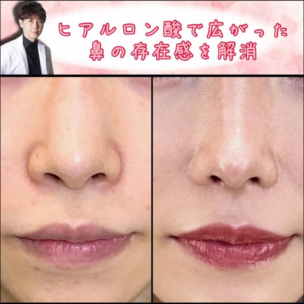 鼻尖形成と軟骨移植と鼻中隔延長とプロテーゼと小鼻縮小とヒアルロン酸溶解注射の症例写真 (2)