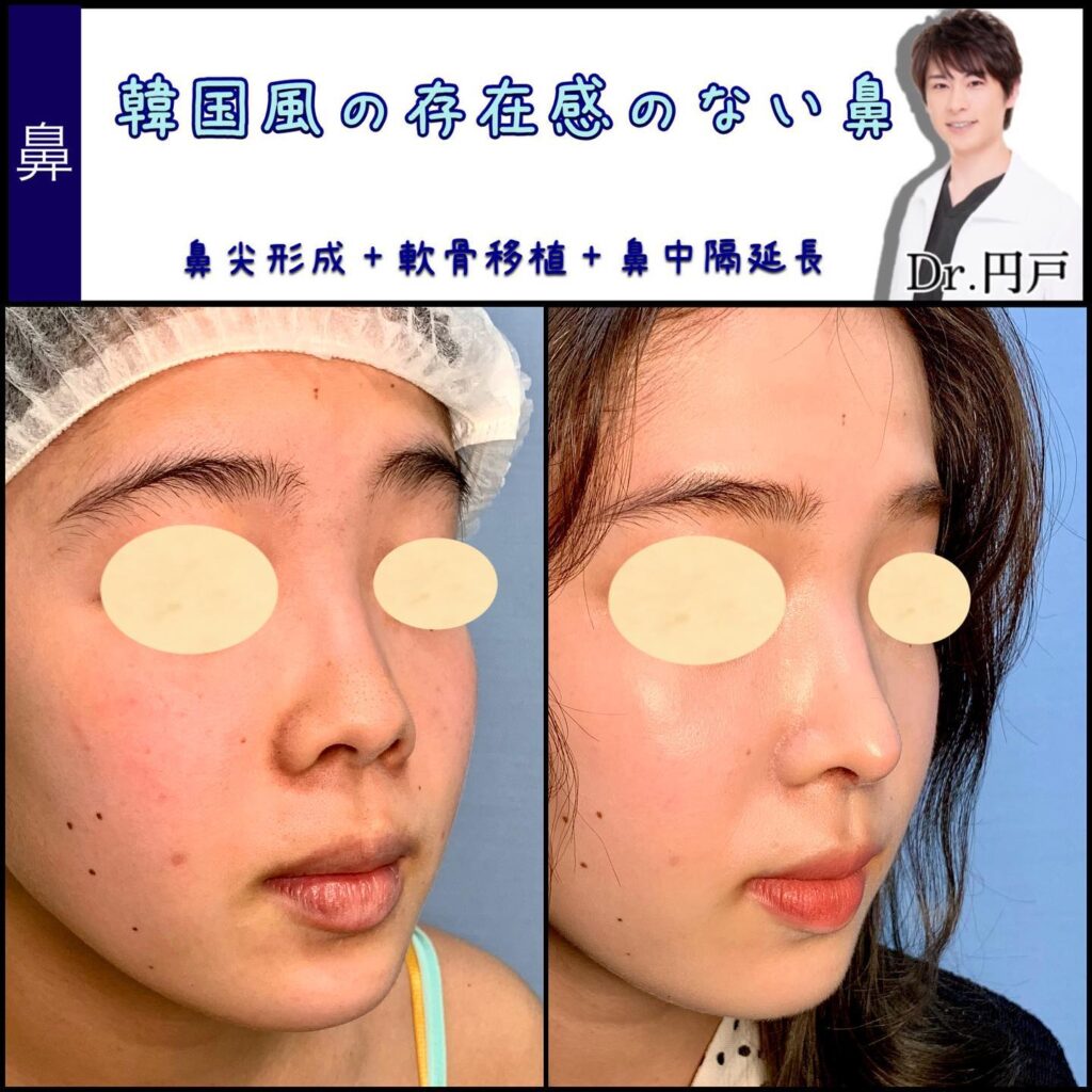 鼻尖形成と軟骨移植と鼻中隔延長の症例写真 (6)