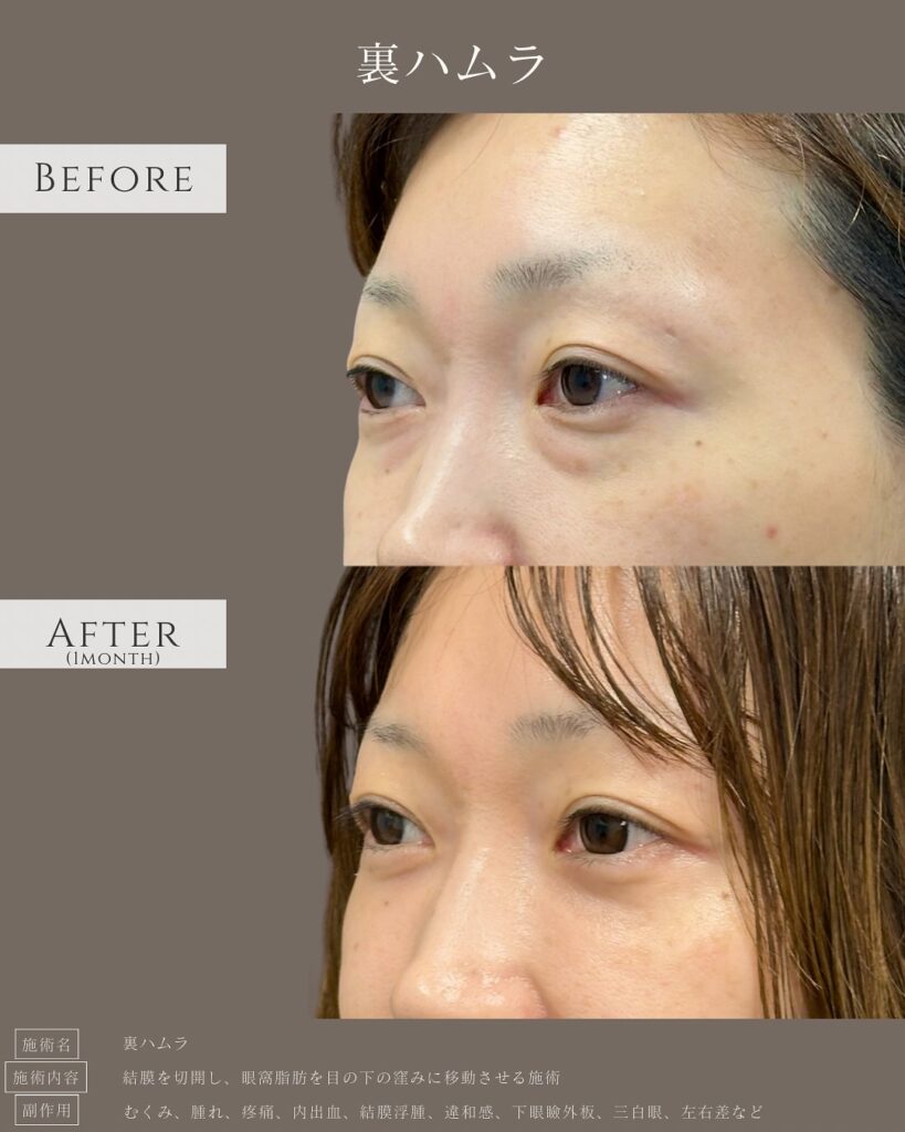 裏ハムラ法の症例写真 (4)