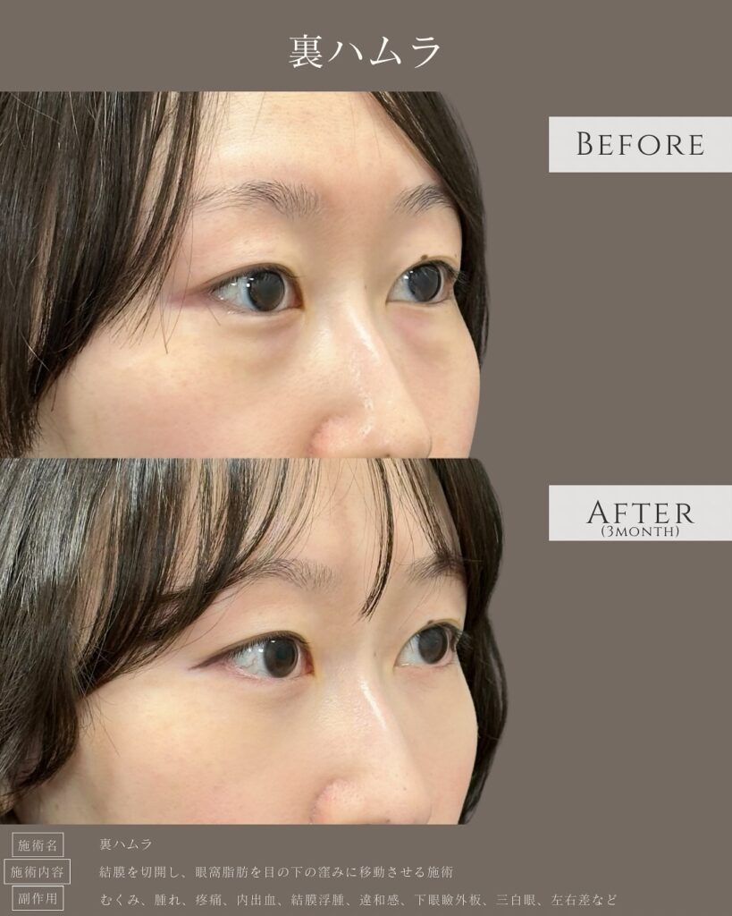 裏ハムラ法の症例写真 (29)