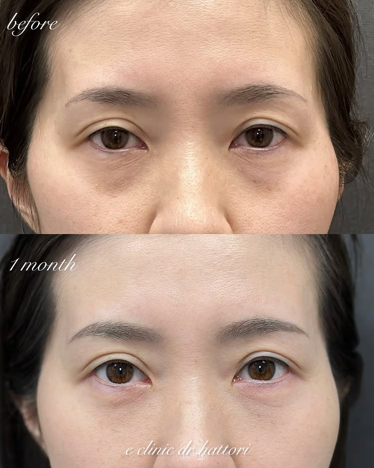 裏ハムラ法の症例写真 (63)