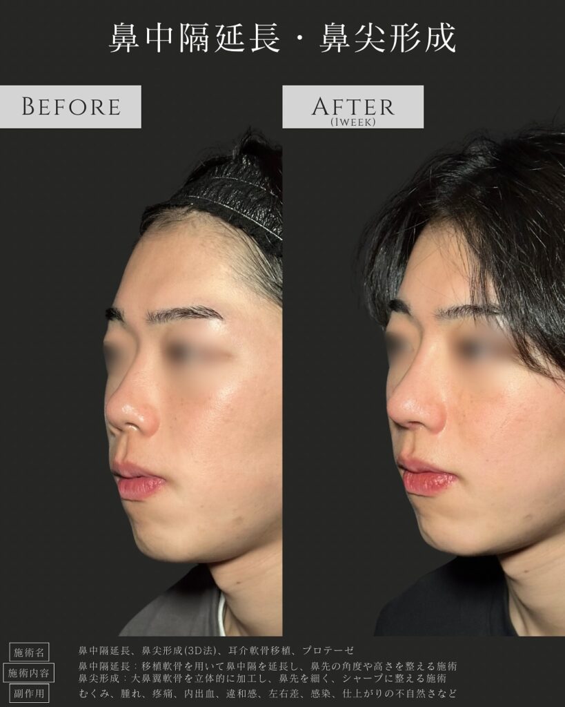 鼻中隔延長と鼻尖形成と耳介軟骨移植とプロテーゼの症例写真 (2)