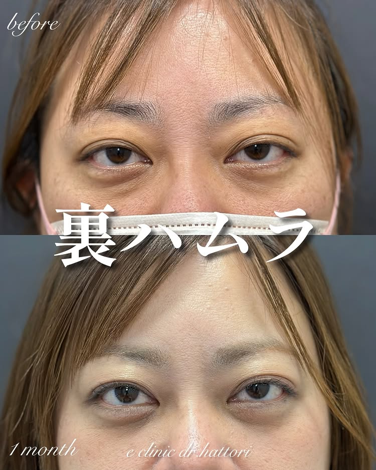 裏ハムラ法の症例写真 (59)