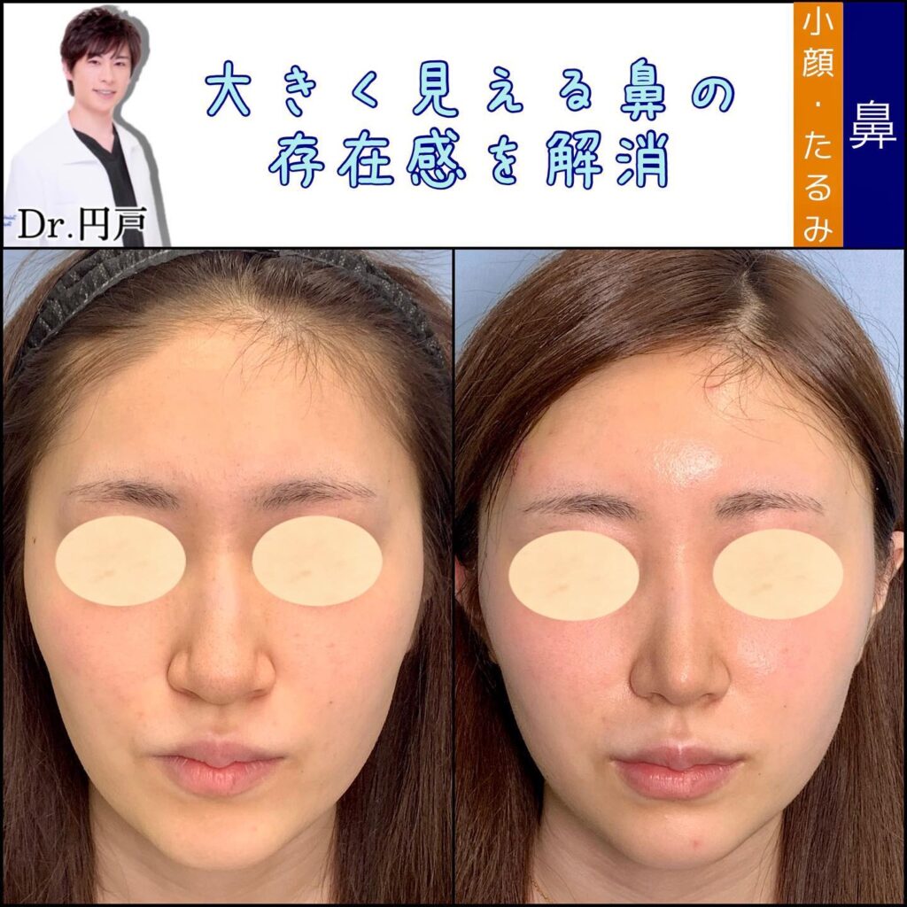 鼻尖形成と軟骨移植と鼻中隔延長と小鼻縮小と脂肪輪郭形成の症例写真