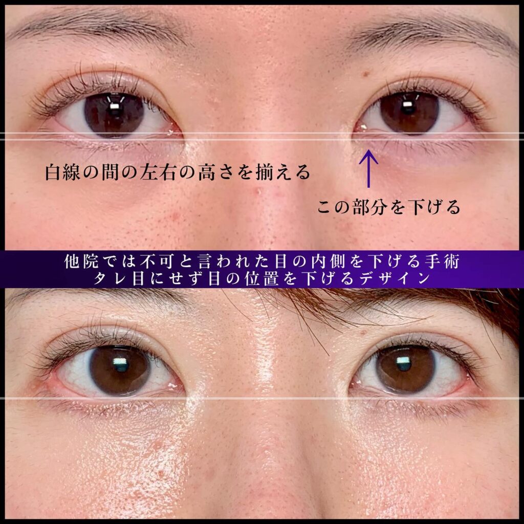 下瞼形成と目尻靭帯移動の症例写真 (1)