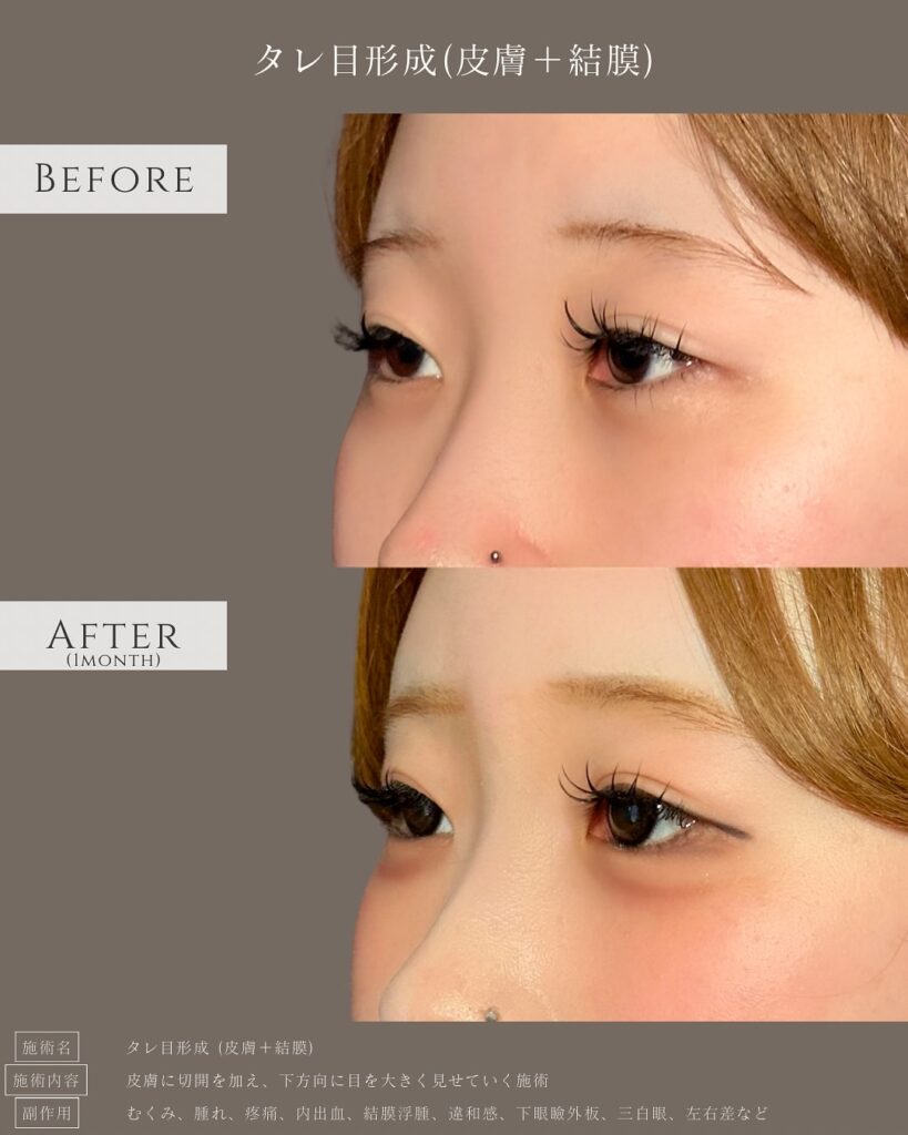 タレ目形成の症例写真 (7)