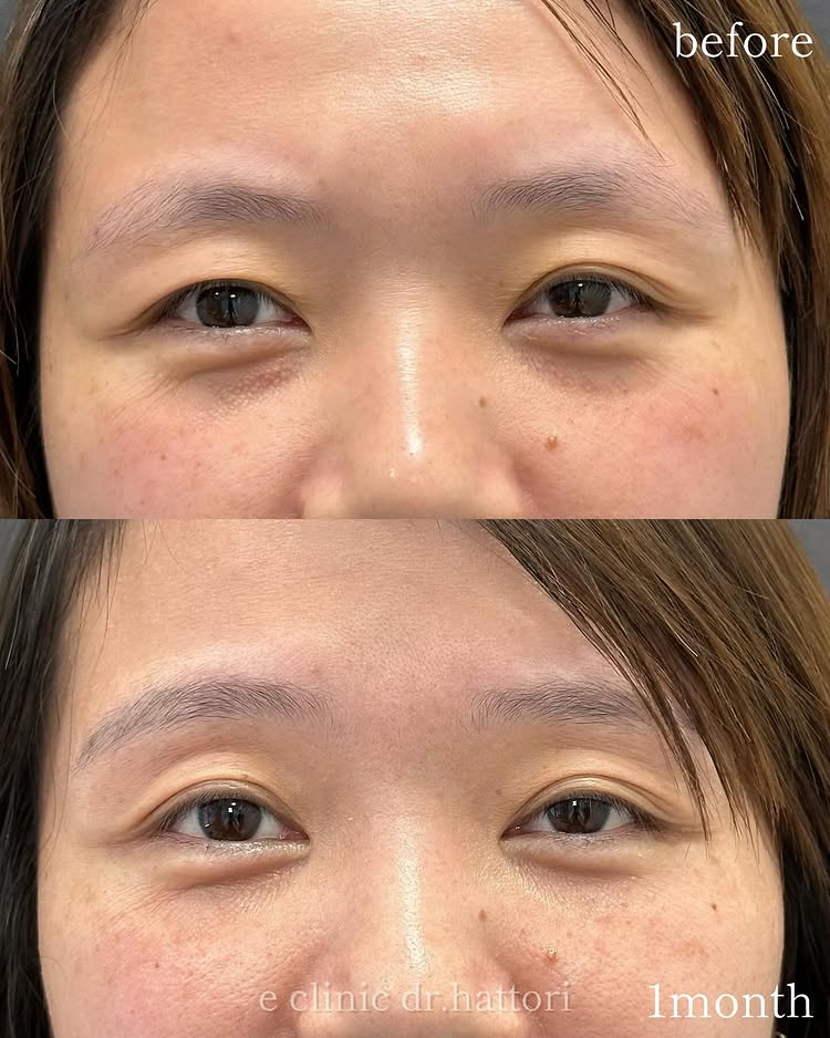 裏ハムラ法の症例写真 (71)