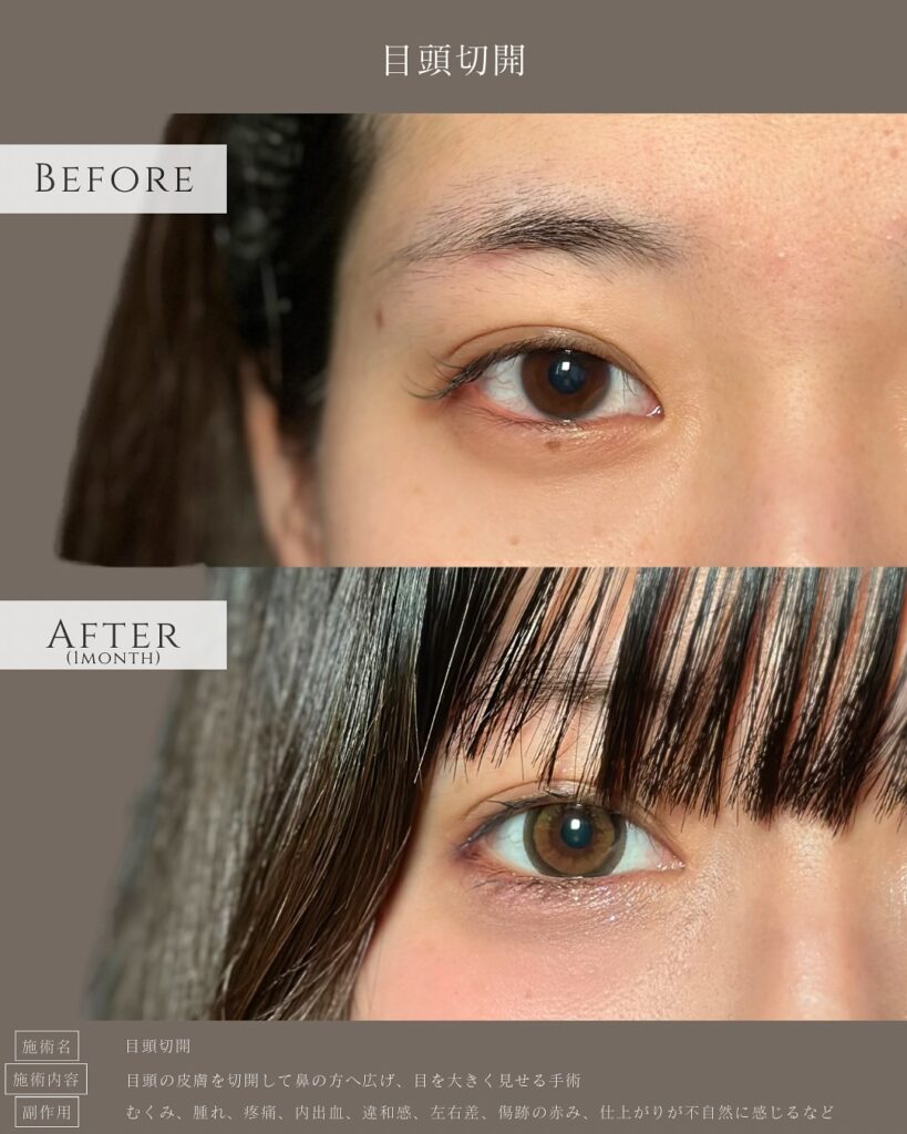目頭切開の症例写真 (3)