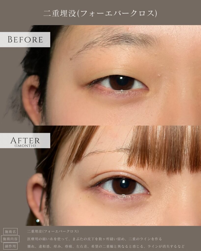 埋没法の症例写真 (10)