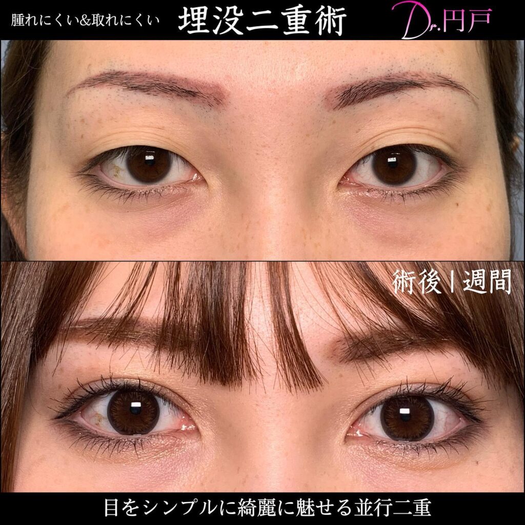 埋没法の症例写真 (10)