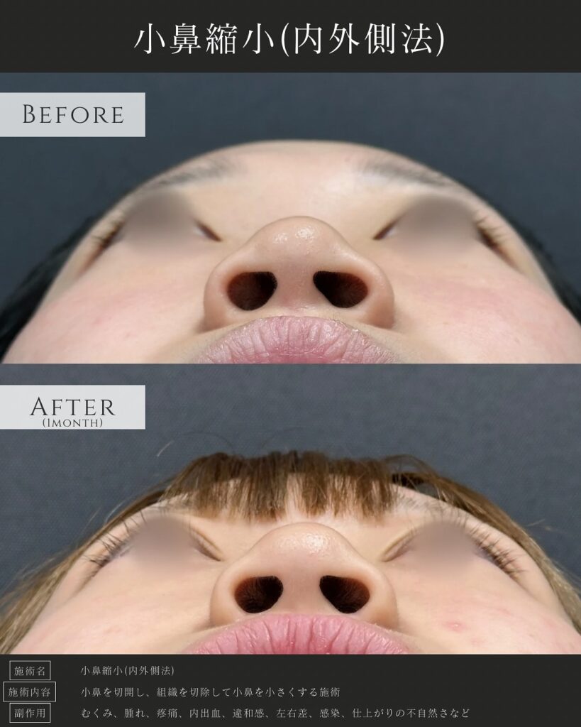 小鼻縮小の症例写真 (8)