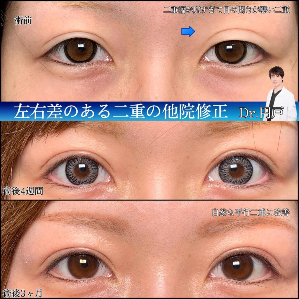 全切開二重と眼瞼下垂の他院修正の症例写真