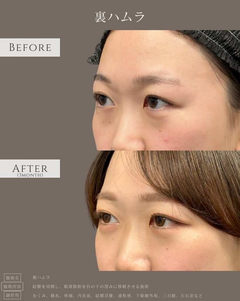 裏ハムラ法の症例写真 (2)