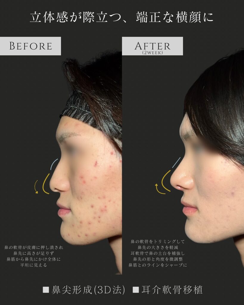 鼻尖形成と耳介軟骨移植の症例写真 (6)