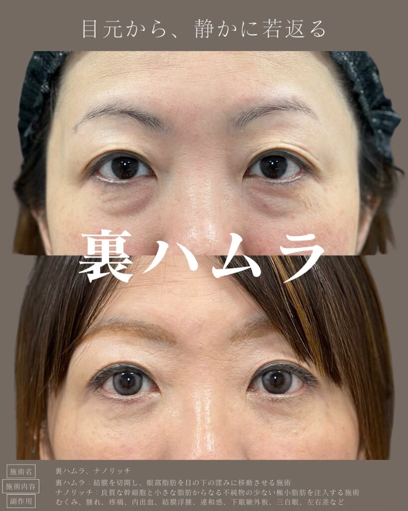 裏ハムラ法とナノリッチの症例写真 (5)