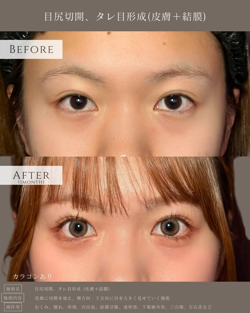 目尻切開とタレ目形成の症例写真 (22)