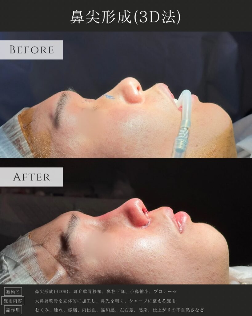 鼻尖形成と耳介軟骨移植と小鼻縮小とプロテーゼと鼻柱下降の症例写真 (7)