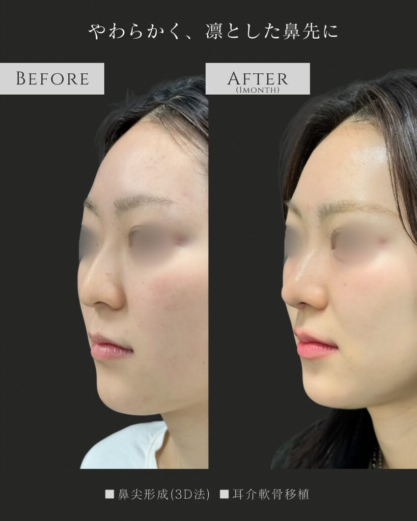 鼻尖形成と耳介軟骨移植の症例写真 (31)