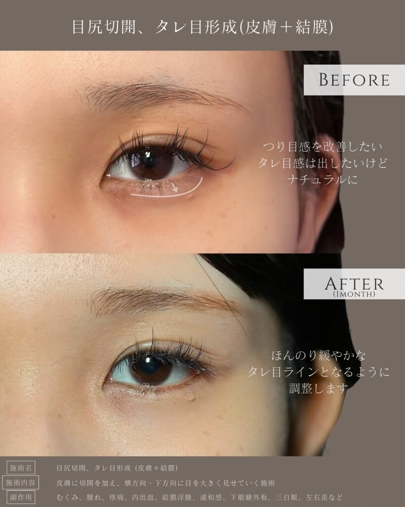 目尻切開とタレ目形成の症例写真 (28)