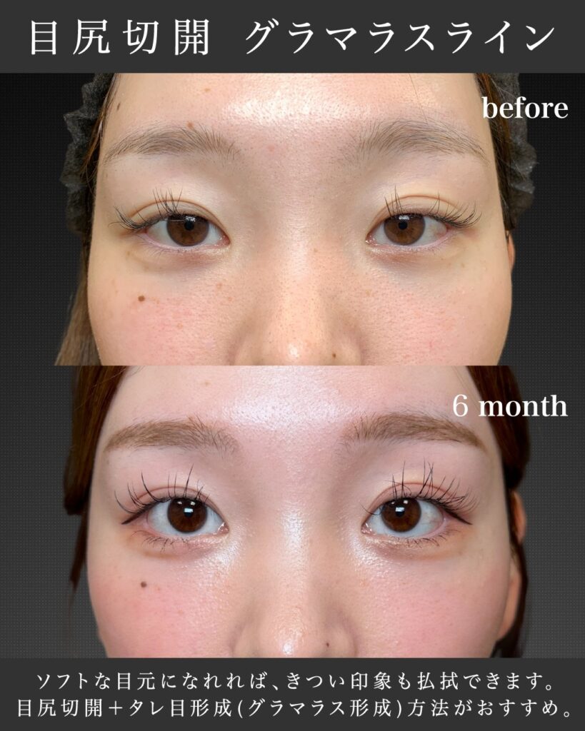 目尻切開とグラマラスライン形成の症例写真 1