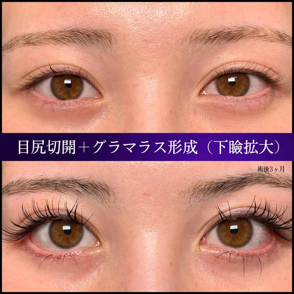 目尻切開とグラマラスライン形成の症例写真 (1)