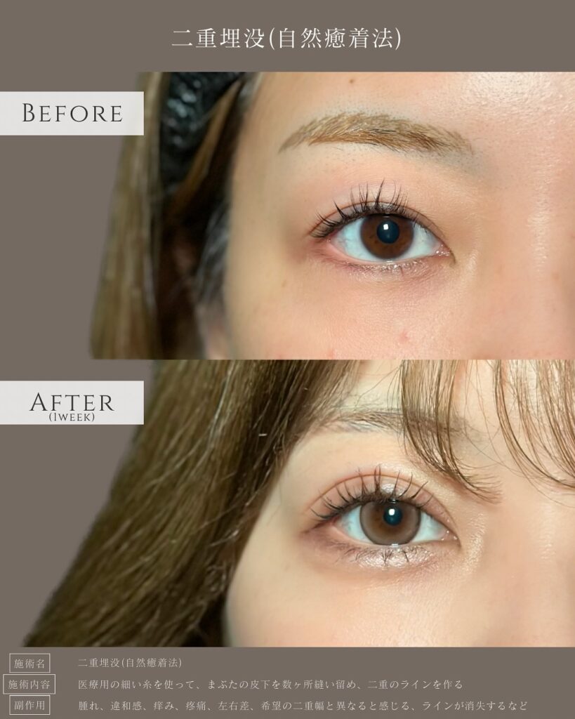 自然癒着法の症例写真 (9)