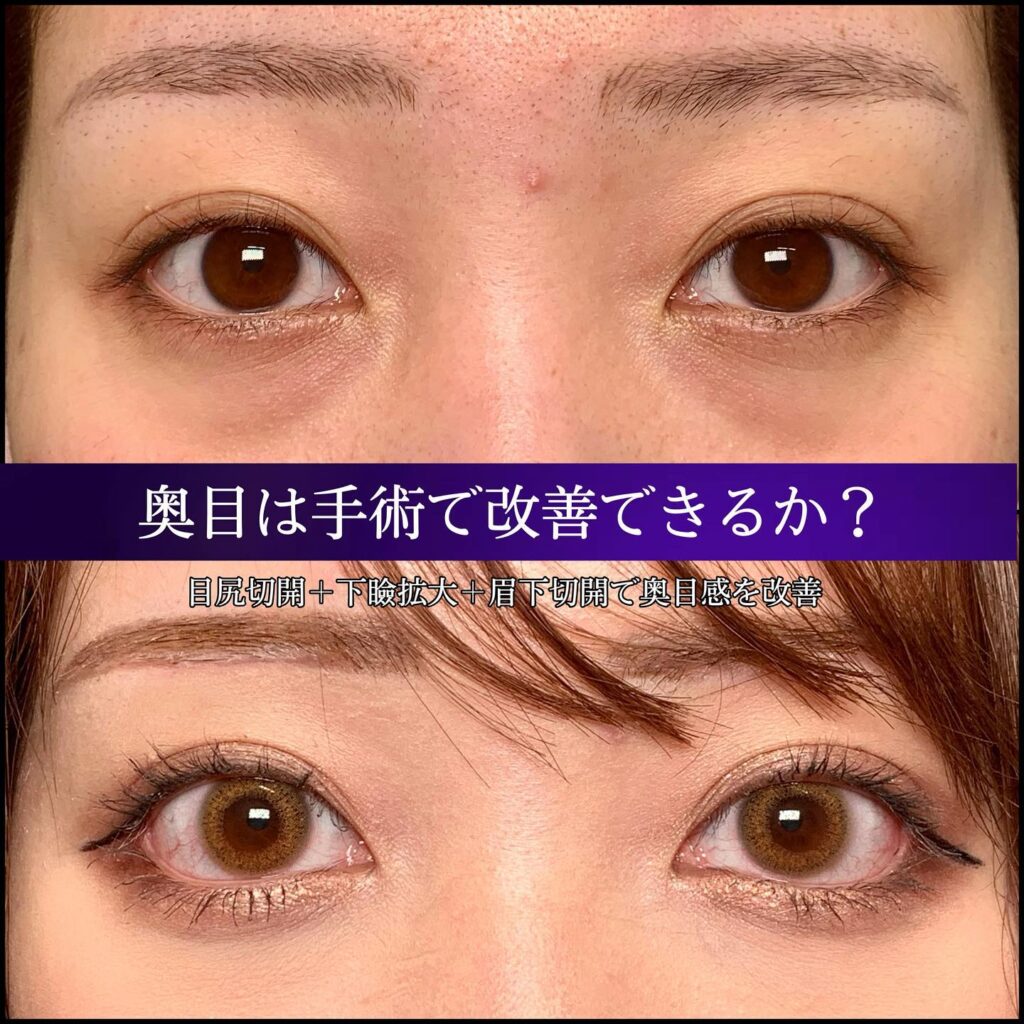 目尻切開と下瞼拡大と目尻切開の症例写真 (1)