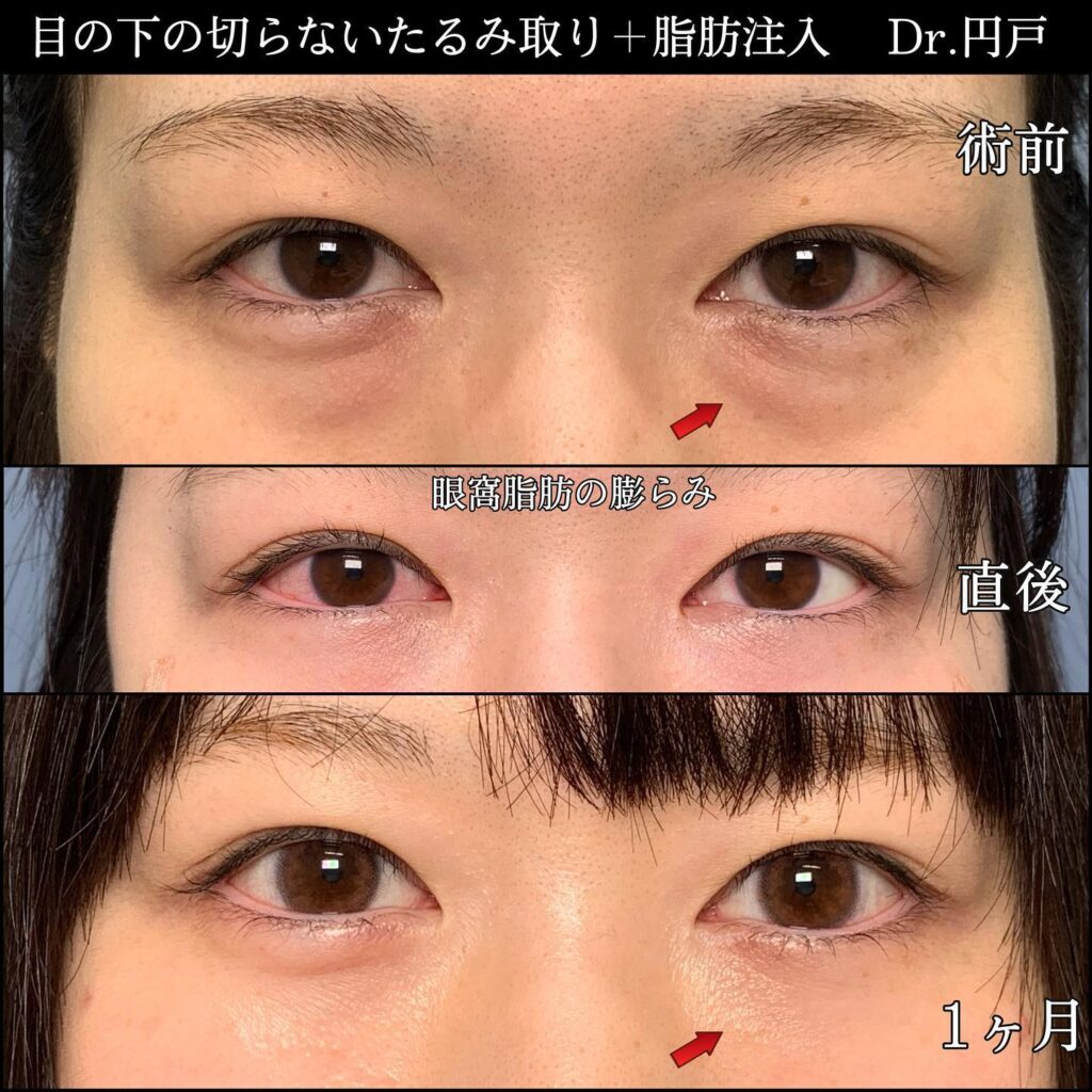 切らない目の下のたるみ取りと脂肪注入の症例写真