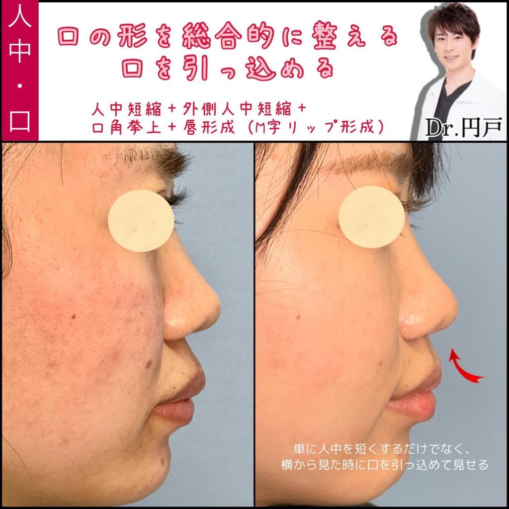 内側人中短縮と外側人中短縮と口角挙上とM字リップ形成を同時に行って口を引っ込めた症例の横から見た写真
