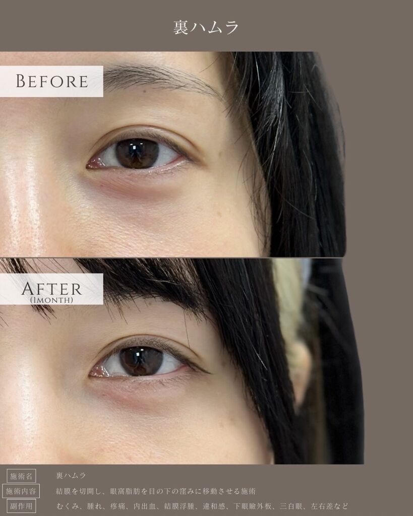 裏ハムラ法の症例写真 (49)