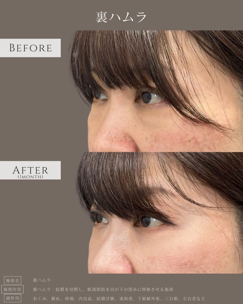 裏ハムラ法の症例写真 (37)