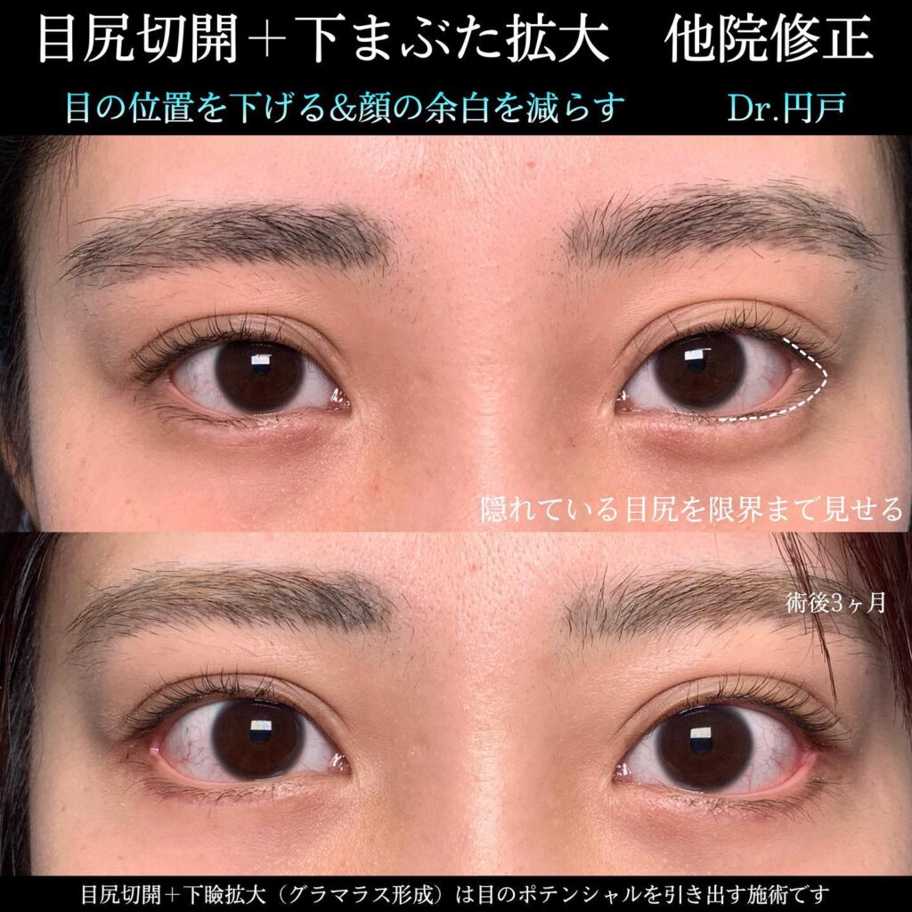 目尻切開とタレ目(グラマラス)形成と他院修正の症例写真