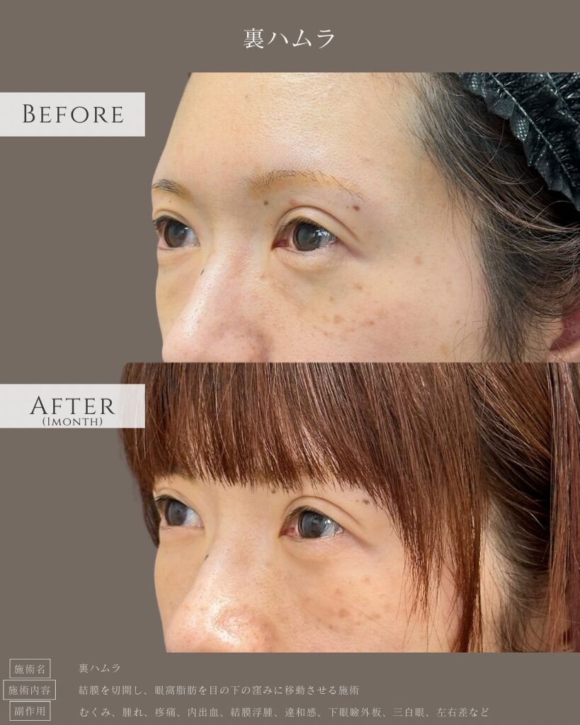 裏ハムラ法の症例写真 (44)