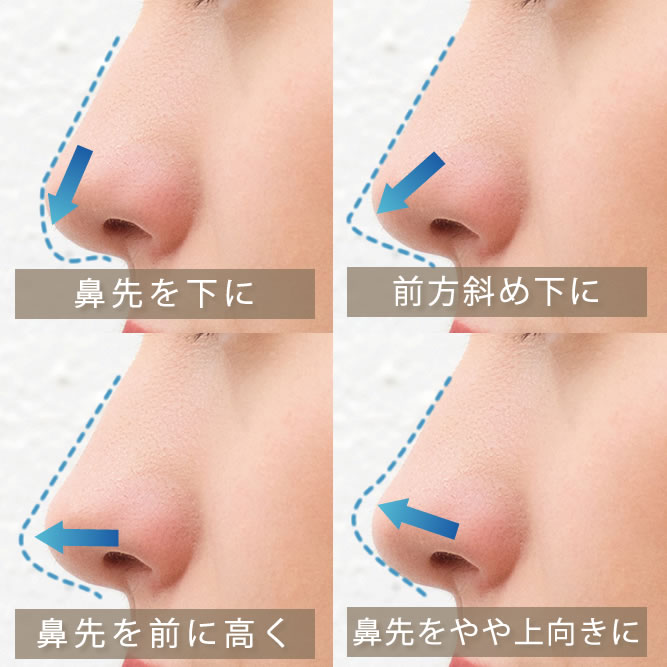 鼻中隔延長の鼻先の向きの分類