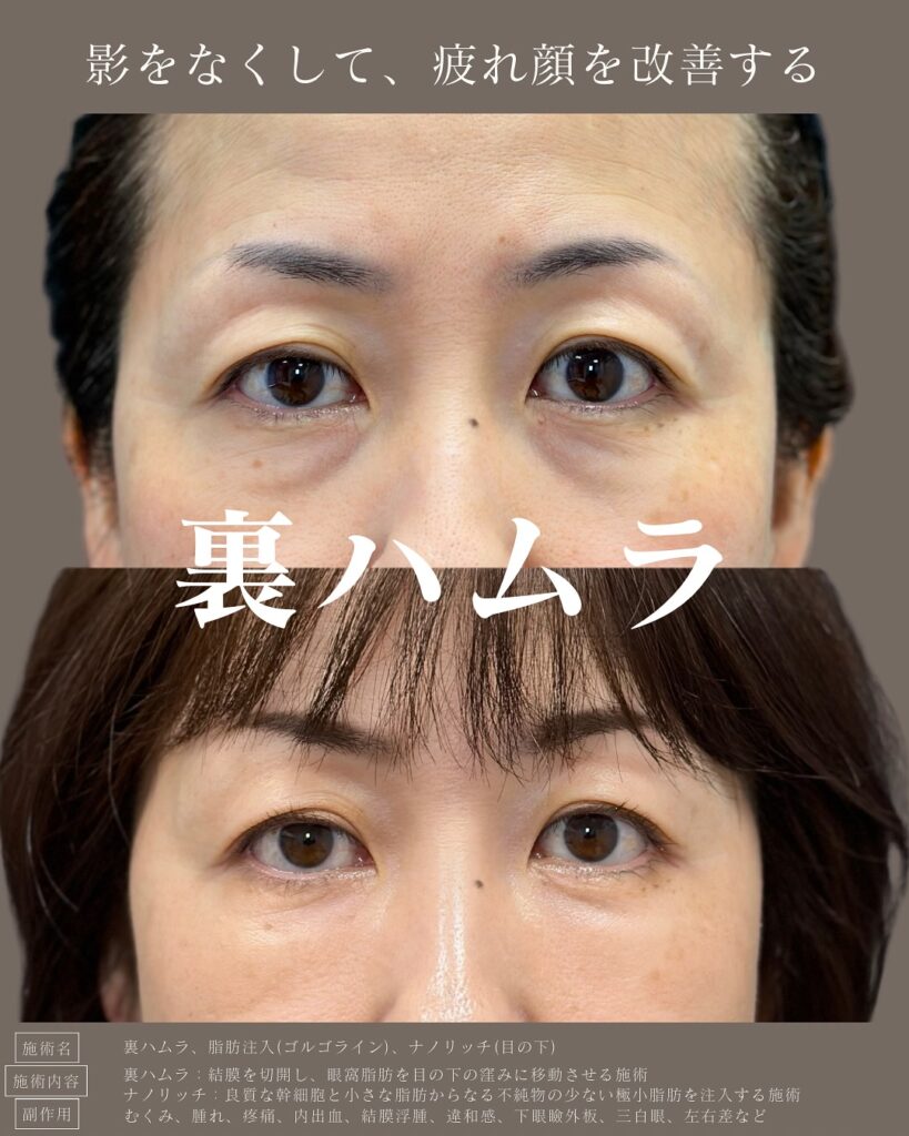 裏ハムラ法と目の下の脂肪注入の症例写真 (1)