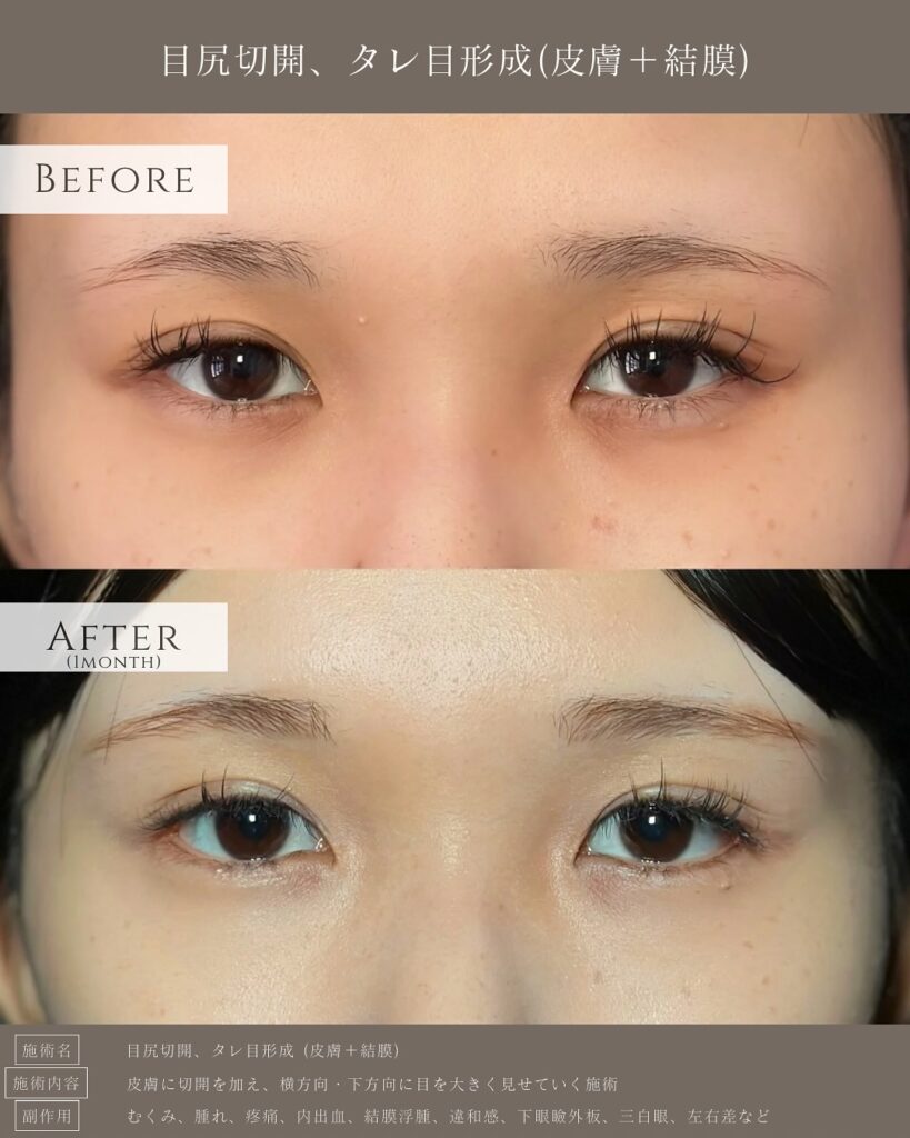 目尻切開とタレ目形成の症例写真 (25)