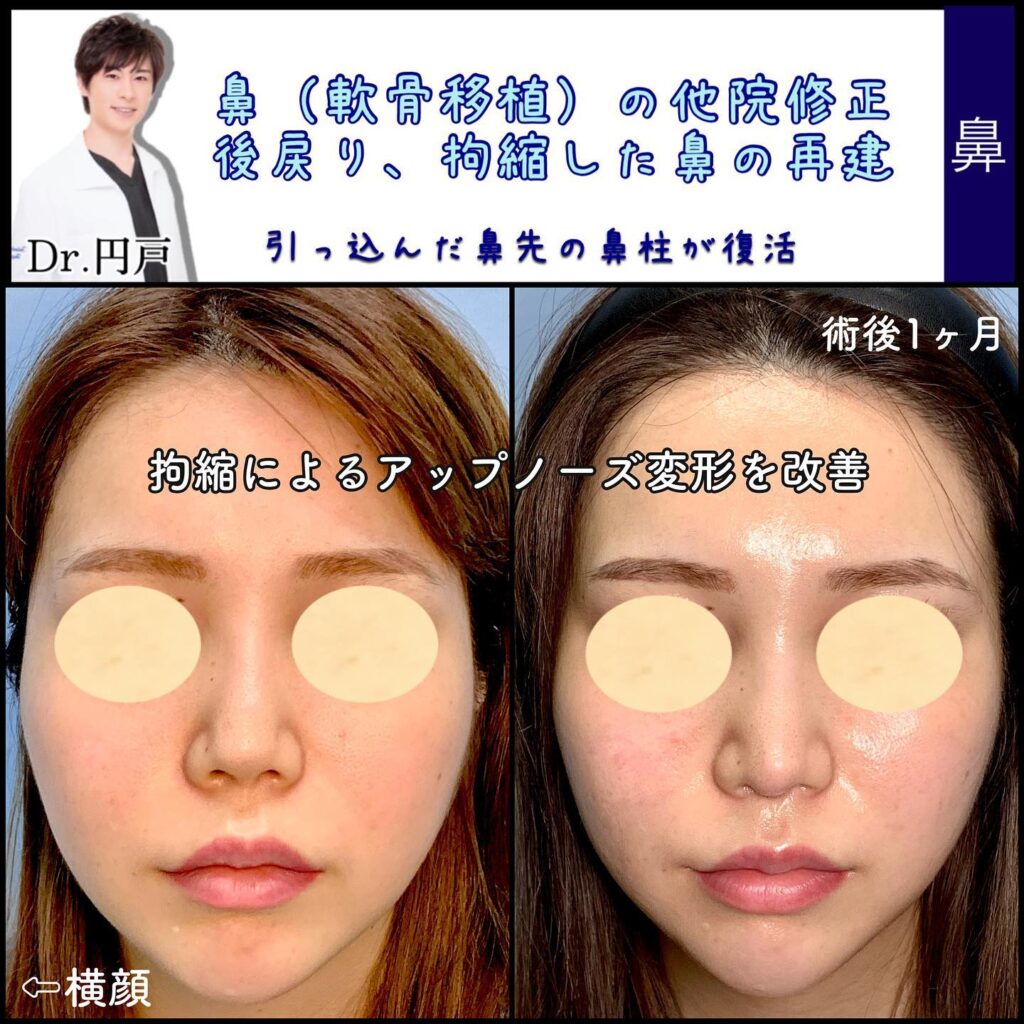 軟骨移植の他院修正の症例写真 (2)