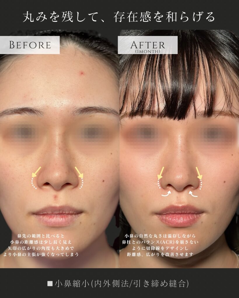小鼻縮小の症例写真 (1)