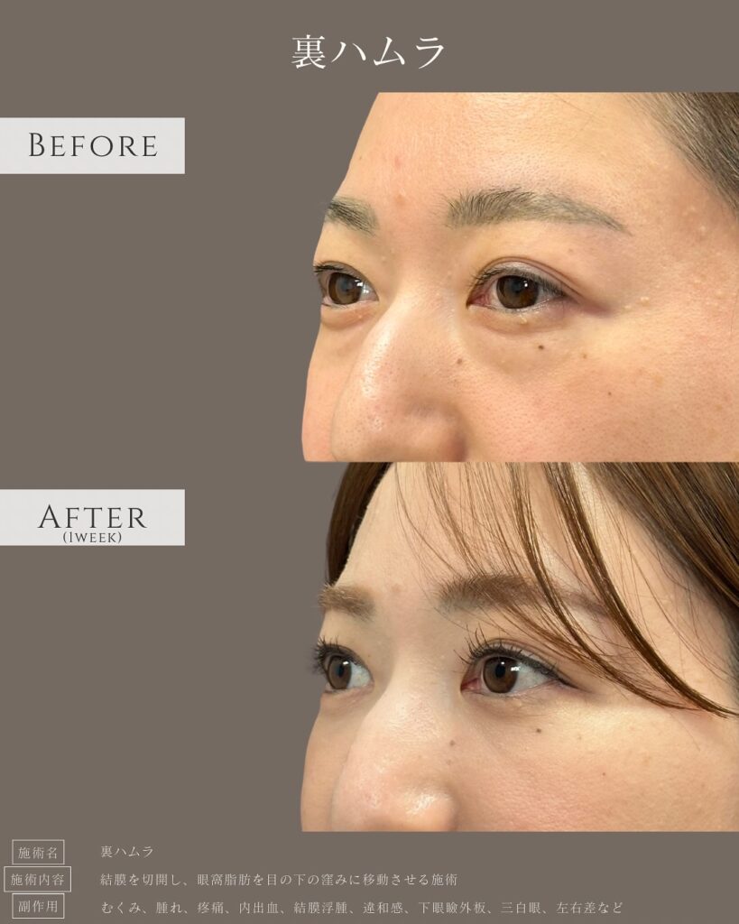 裏ハムラ法の症例写真 (15)