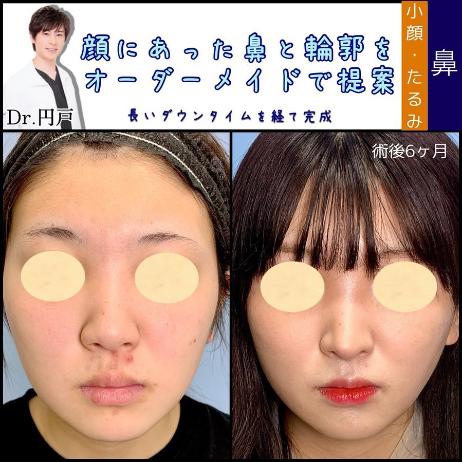 鼻中隔延長の症例写真 (1)