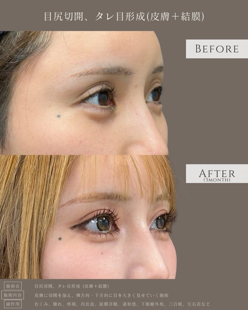 目尻切開とタレ目形成の症例写真 (31)