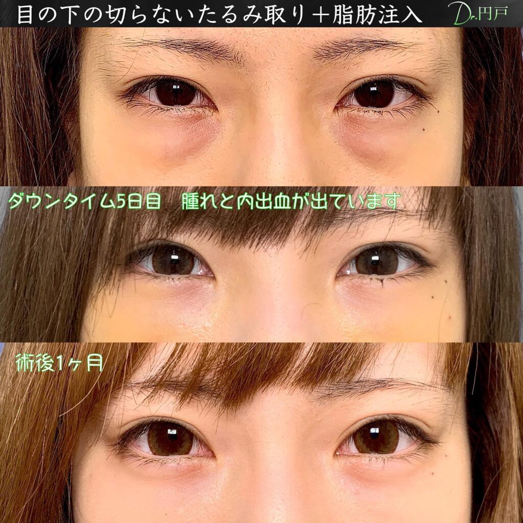 目の下の切らないたるみ取りと脂肪注入の症例写真