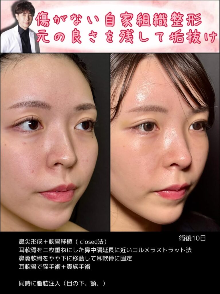 クローズド法の鼻尖形成と軟骨移植の症例写真 (8)