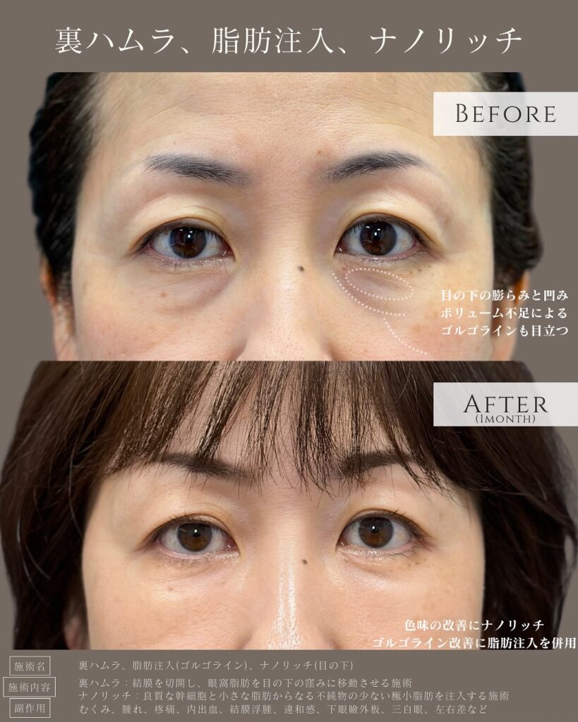 裏ハムラ法と目の下の脂肪注入の症例写真 (3)